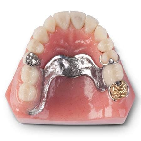 Dental Model Overdenture Implant Restoration Model CB-10
