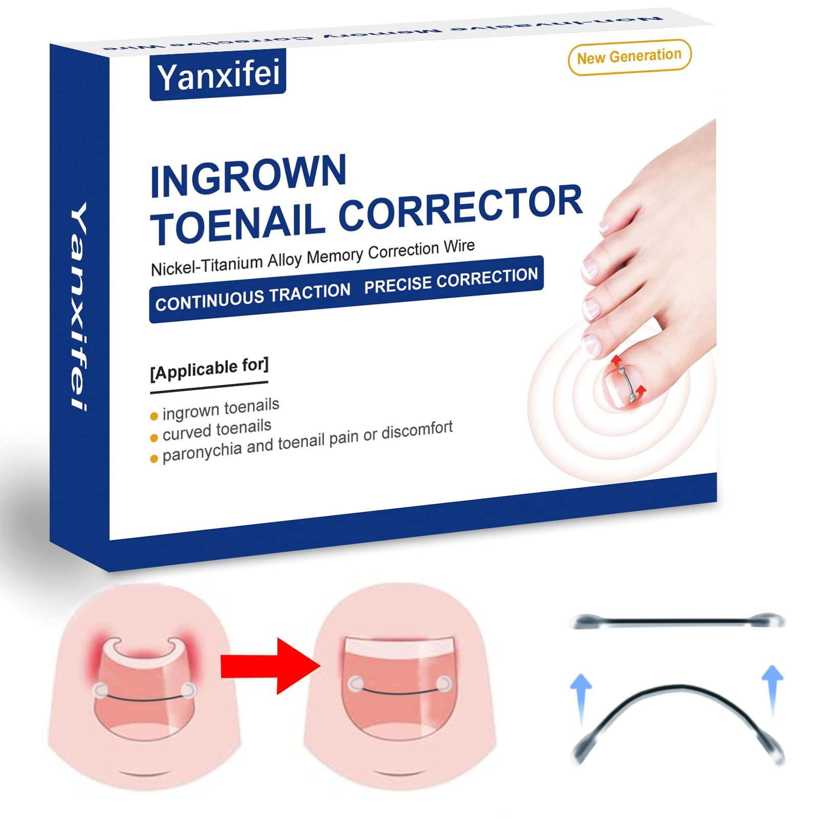 Nitinol Ingrown Toenail Corrector,at Home Ingrown Toenail Treatment,Curved Toenail Straightener,Ingrown Toe Nail Relief,Ingrown Toenail Removal Kit (11/16 In,13/16 In)