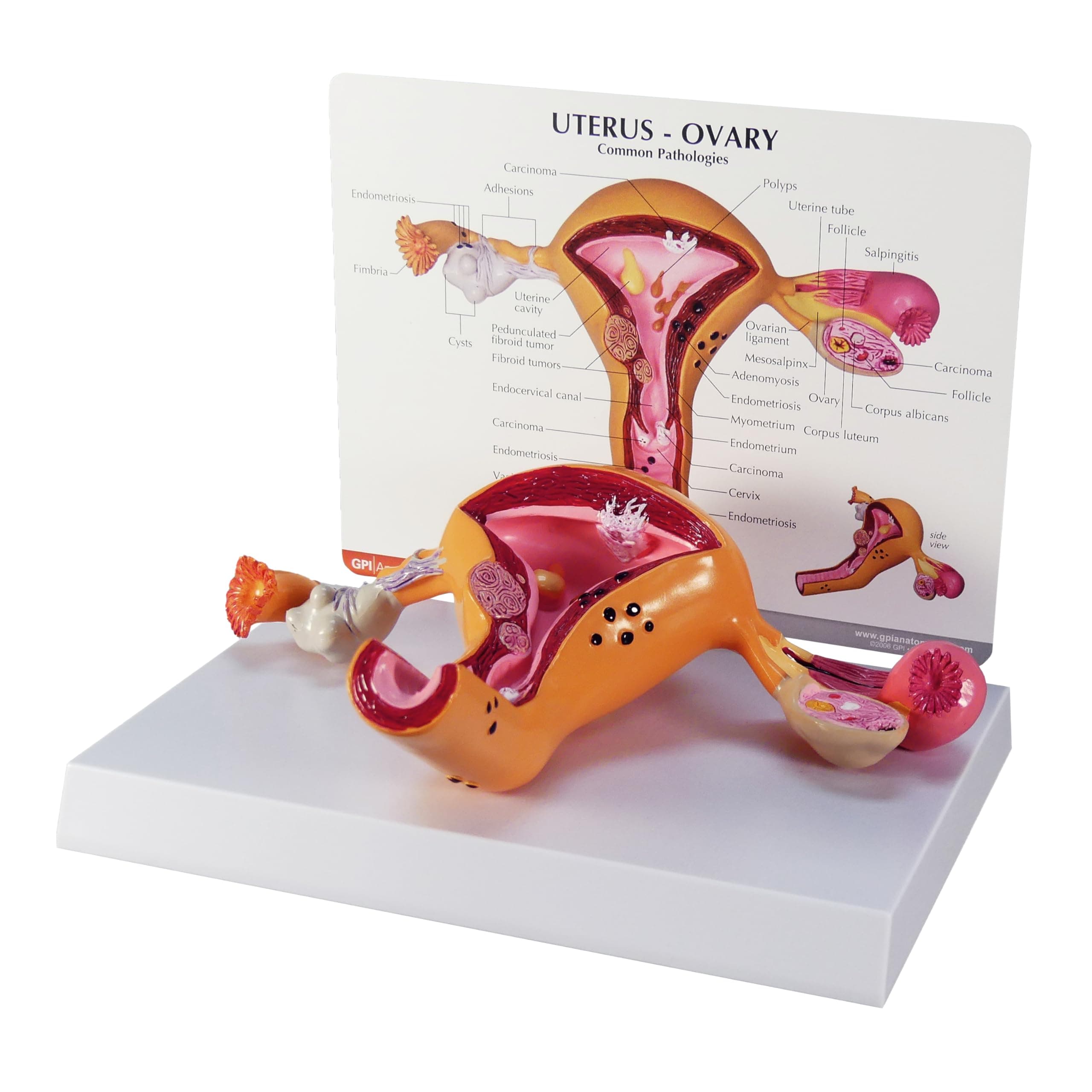 GPI Anatomicals - Uterus and Ovary Model, Model of Female Reproductive System for Human Anatomy and Physiology Education, Anatomy Model for Doctor's Office and Classrooms, Medical Learning Resources
